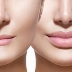 Botox Lip Injections