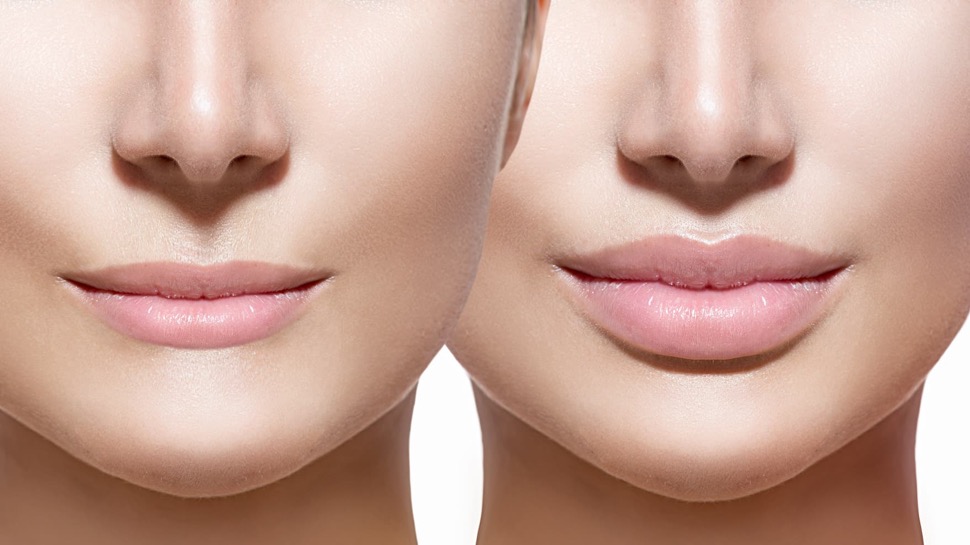 Botox Lip Injections